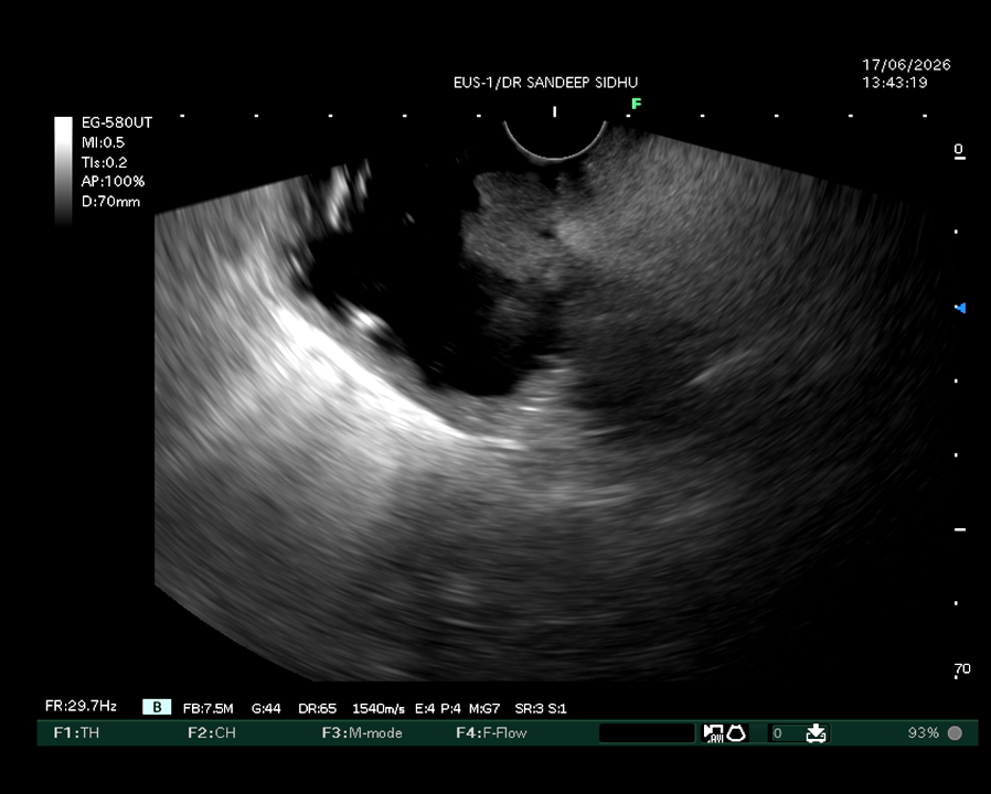 Ampulectomy