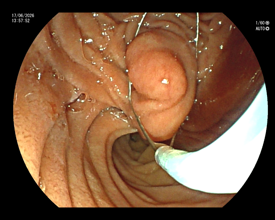 Ampulectomy