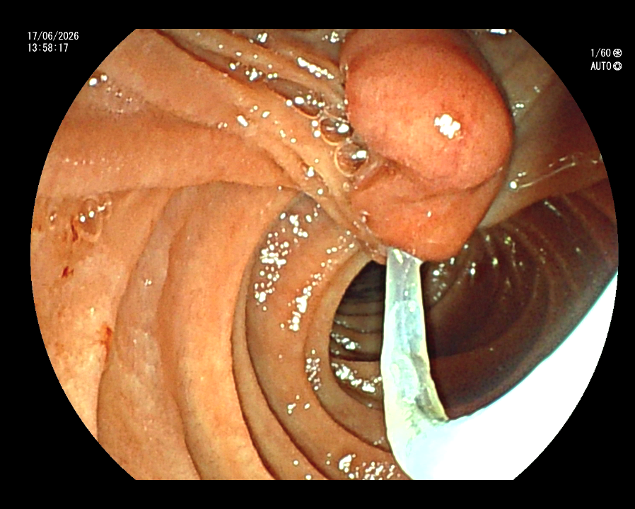 Ampulectomy