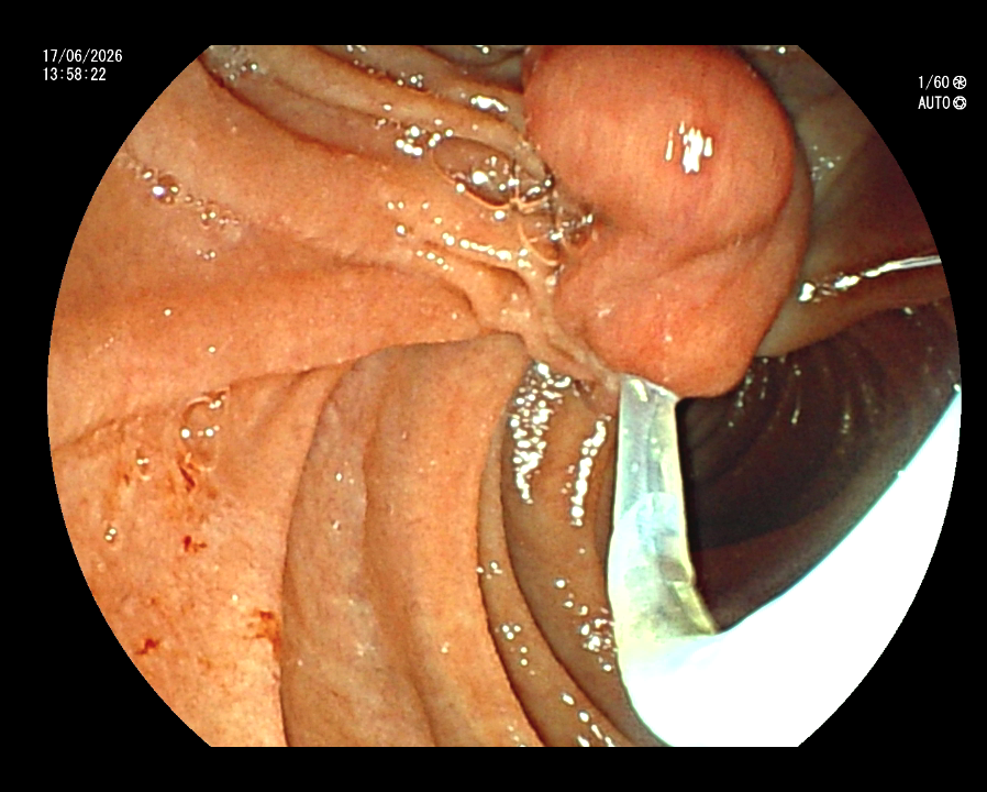 Ampulectomy
