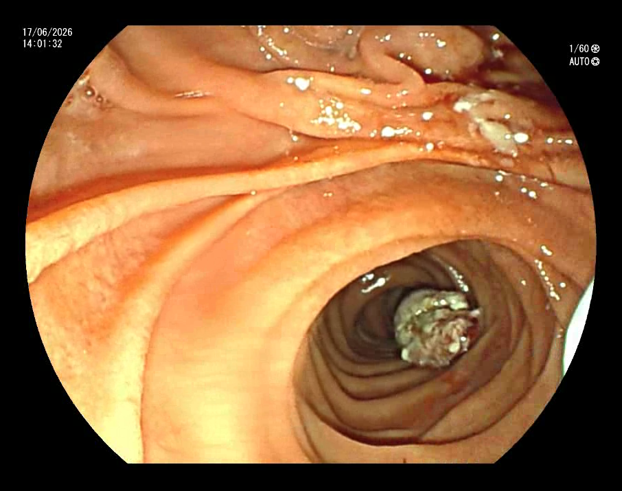 Ampulectomy