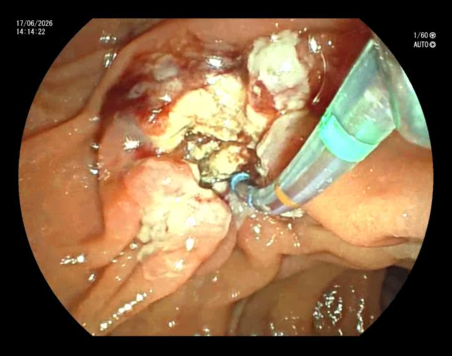 Ampulectomy
