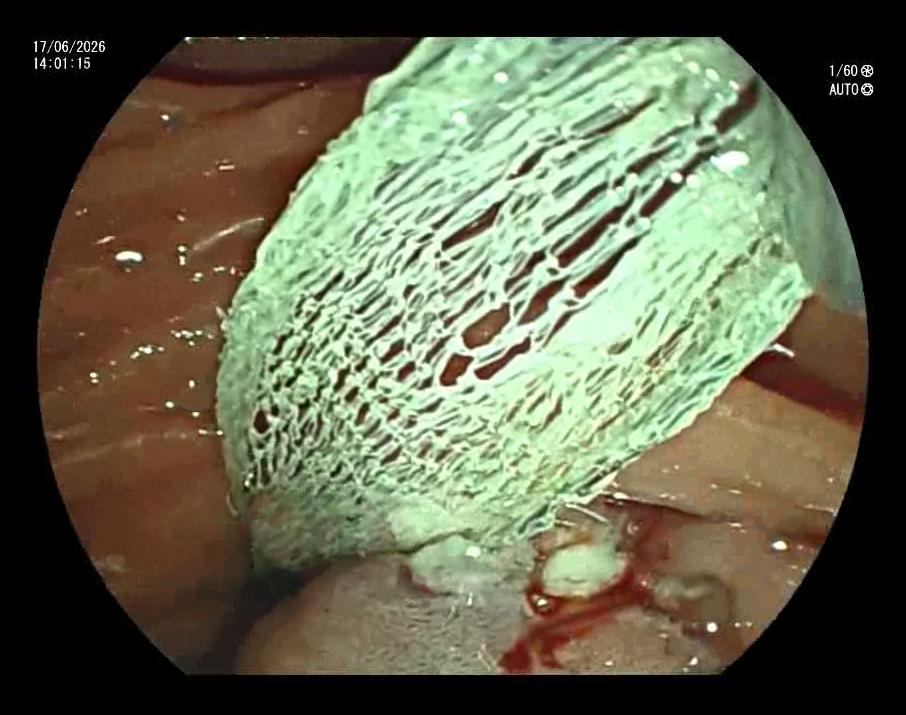 Ampulectomy