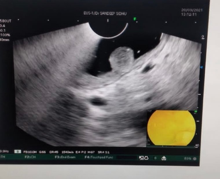 Therapeutic Endoscopic Ultrasound