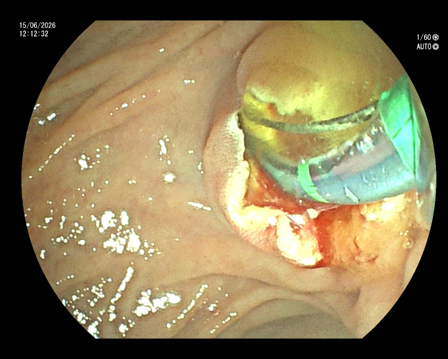 ERCP