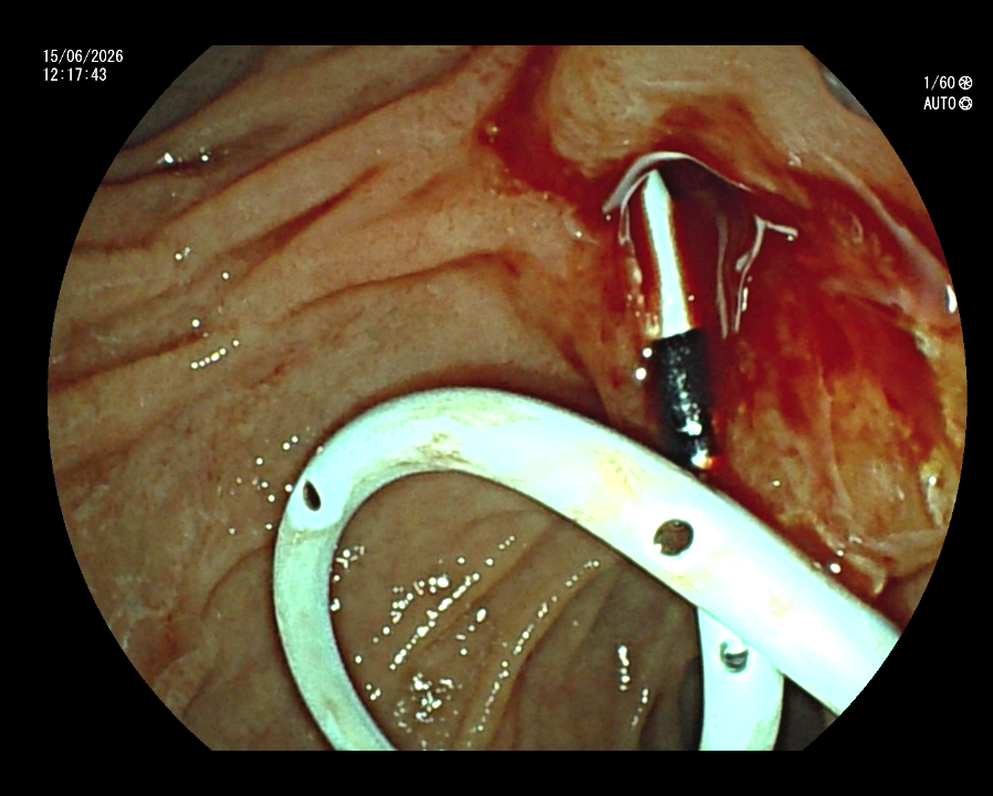 ERCP