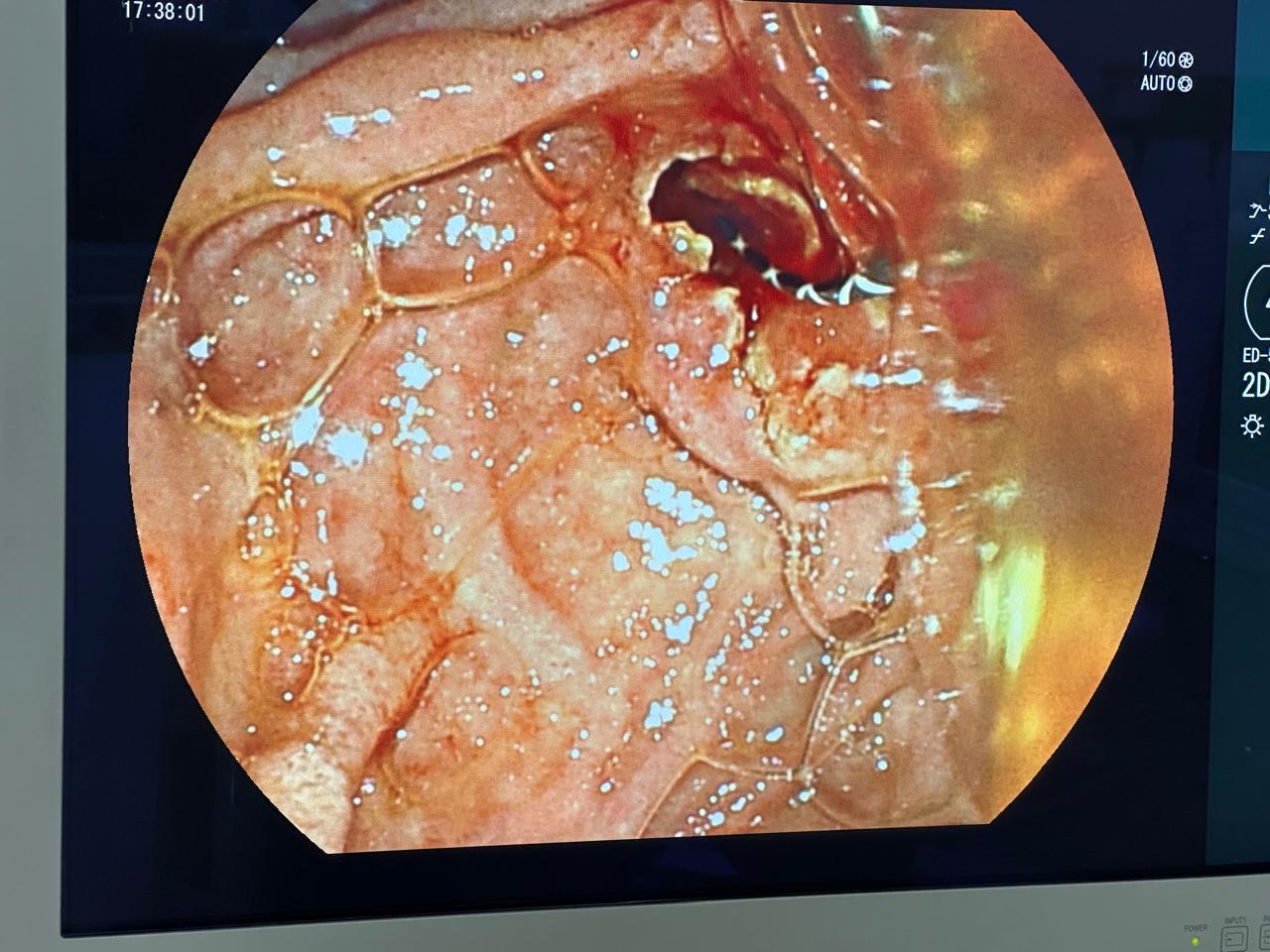 ERCP