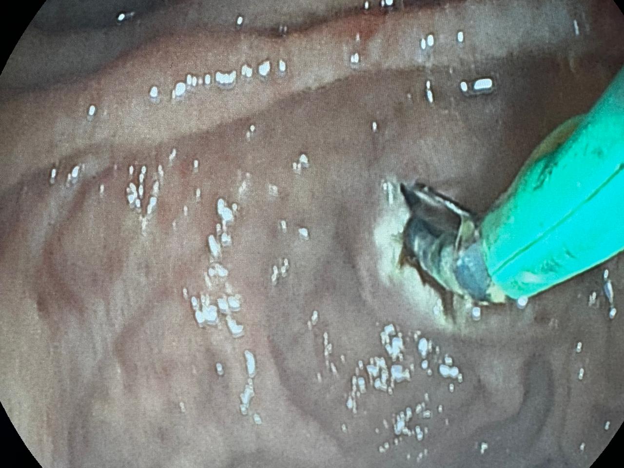ERCP