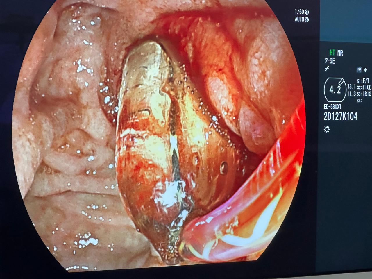 ERCP