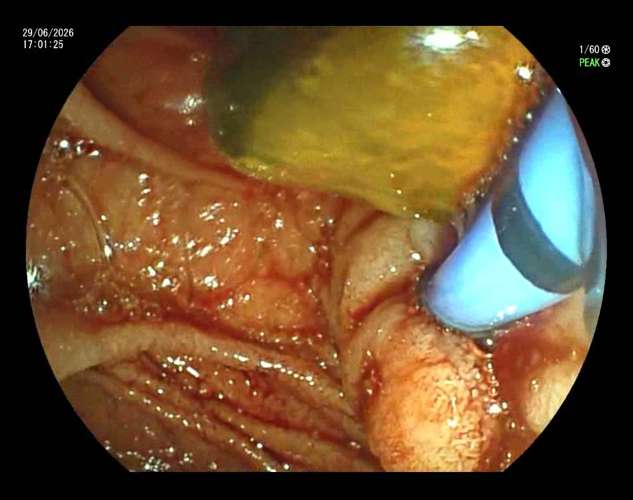 ERCP