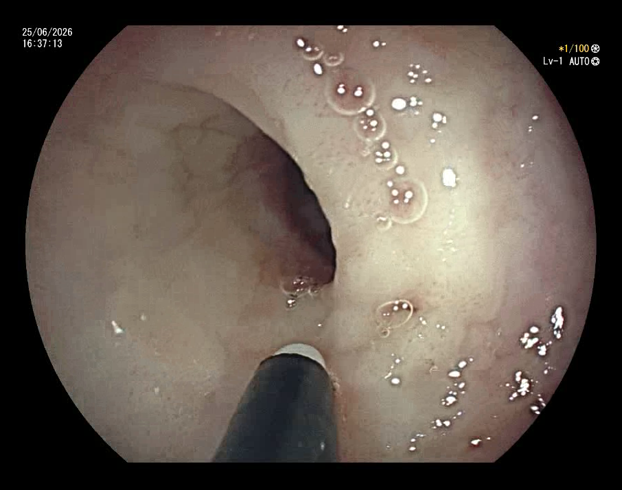 Stricture