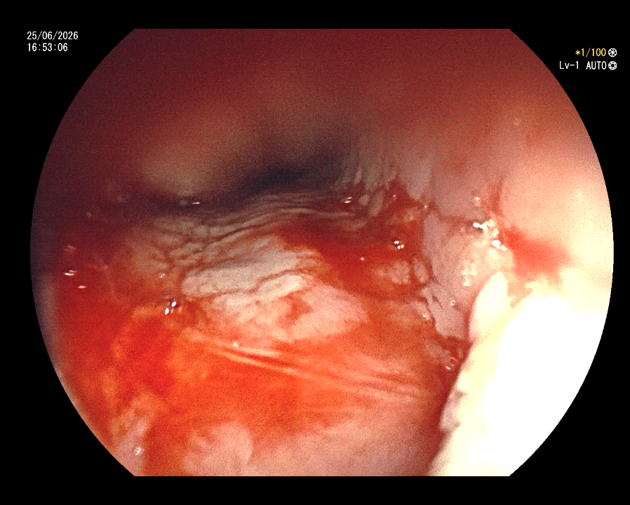 Stricture